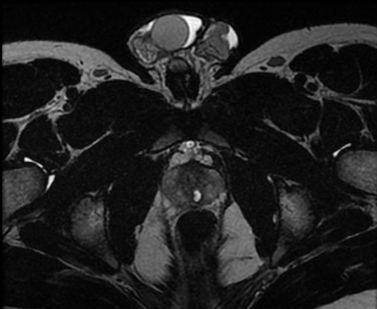 <b>Figure 3.</b> Axial T2-weighted MRI of the pelvis demonstrating a periurethral cyst.