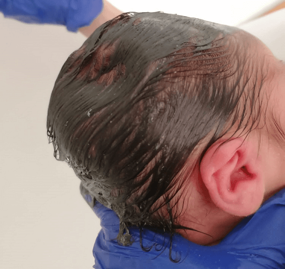 <b>Figure 1.</b> Depression in the newborn’s right parietal bone (at birth).