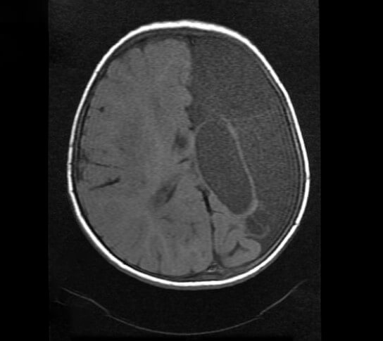 A rare presentation of dyke-davidoff-masson syndrome | Pediatric Oncall ...