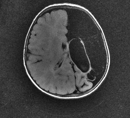 A rare presentation of dyke-davidoff-masson syndrome | Pediatric Oncall ...