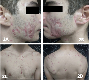 <b>Figure 2.</b> Improvement of active and cicatricial lesions on face (Figure 2A and 2B), chest (Figure 2C) and back (Figure 2D).