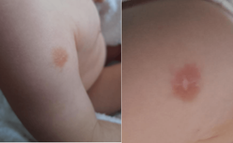 <b>Figure 1.</b> Lesion at 9 months and 18 months.
