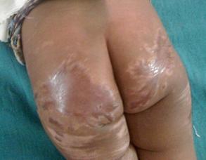 <b>Figure 2: Pyoderma Gangrenosum after skin graft </b>