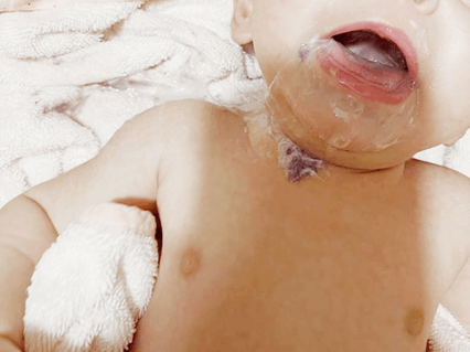 <b>Figure 1.</b> Purple regurgitated gastric contents around the mouth and neck region.