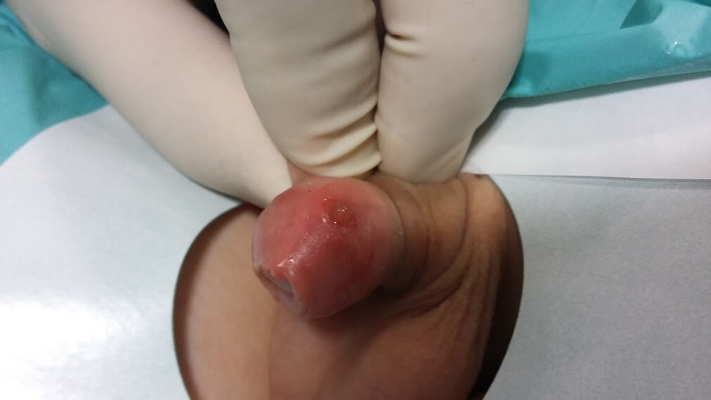 <b>Figure 2.</b> Small laceration at the site of the constricted foreskin.