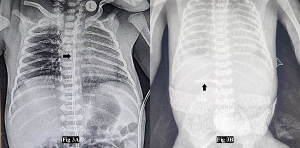 <b>Figure 3.</b> Umbilical Vein Catheter Malpositions: 3A: Right Atrium, 3B: Left Portal Vein.