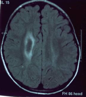<b>Figure 1 : MRI brain showing right front parietal bleed.</b>
