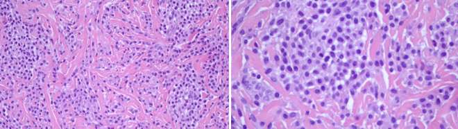 <b>Figure 2.</b> Aggregates of mast cells on skin biopsy.