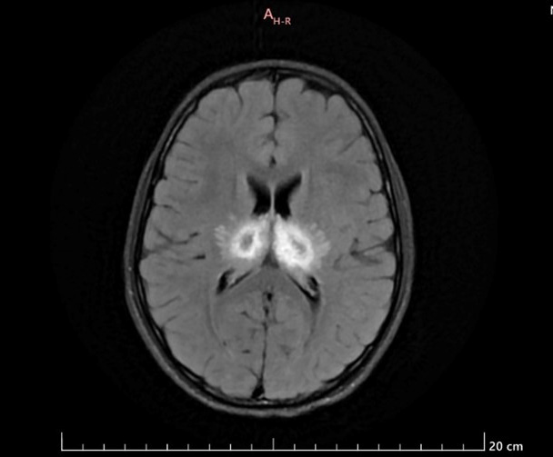<b>Figure 1.</b> MRI finding of the patient with ANEC showing T2 Flair image with bilateral thalamic hyper intensities.