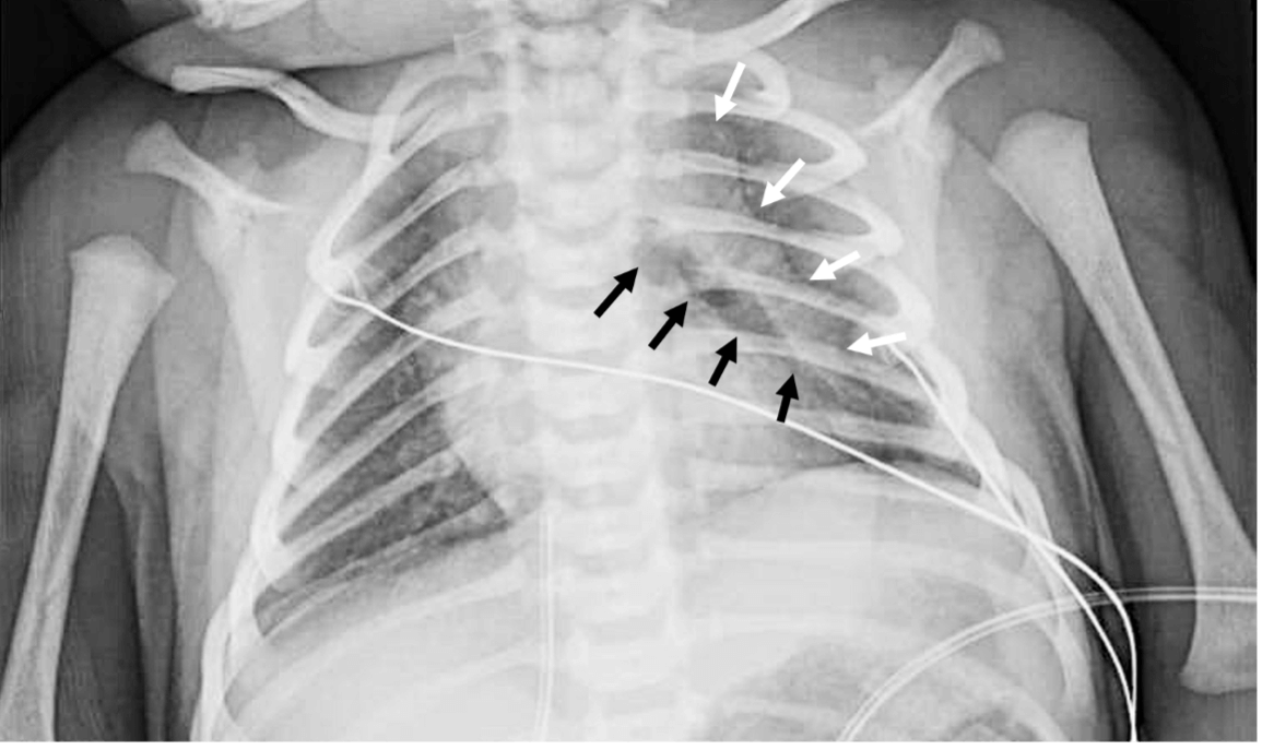 Spinnaker sail Sign A Sign To Neonatal Pneumomediastinum Pediatric 