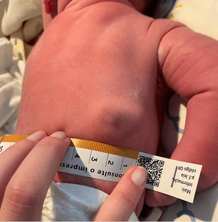 <b>Figure 1.</b> Image of a congenital hemangioma (white arrow), presenting at birth examination as mobile and elastic lumbar mass (violaceous center with pale halo), measuring approximately 20x30 mm.
