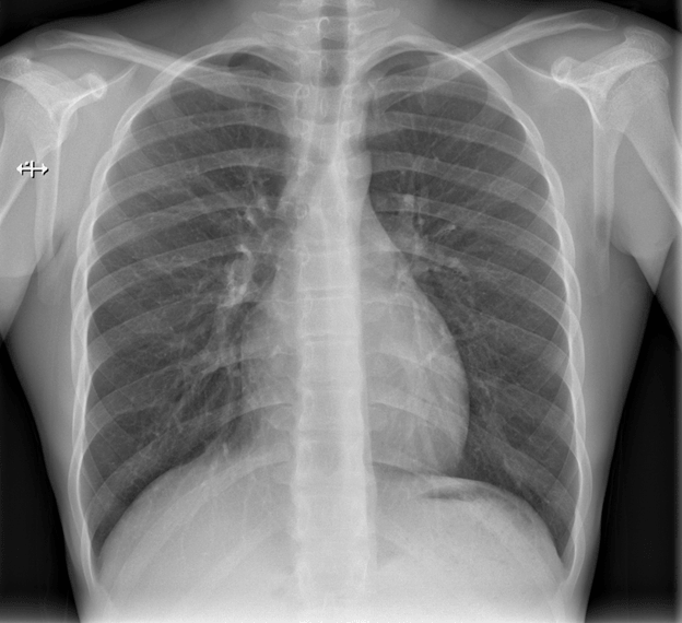 <b>Figure 2.</b> Follow-up posteroanterior chest radiograph after high-flow oxygen therapy demonstrating complete resolution of the previously observed pneumomediastinum, with disappearance of the paratracheal air columns.