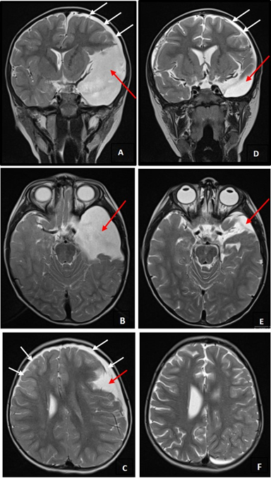 <b>Figure 1.</b> Brain-MRI T2-sequence images. A, B, C - <u>Two days after head trauma:</u> large left anterior temporal CA (evidenced by red arrows), conditioning right deviation of midline structures and left HS (evidenced by white arrows). D, E, F - <u>Seventh month control:</u> significant reduction in left anterior temporal CA dimensions (evidenced by red arrows), with subtle right deviation of midline structures and less thickness of left HS (evidenced by white arrows).