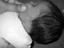 Figure 2: Absent pinna and external auditory canal on right side