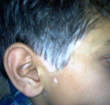 Piebaldism | Spot Diagnosis | Pediatric Oncall