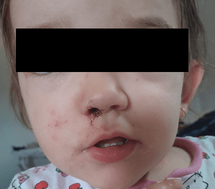 <b>Figure 1.</b> An 18-month-old child at admission showing an excellent overall appearance, maculopapular lesions on the face, smaller than 0.5cm in diameter, and visible dry blood on the right nasal cavity, with no other alterations.