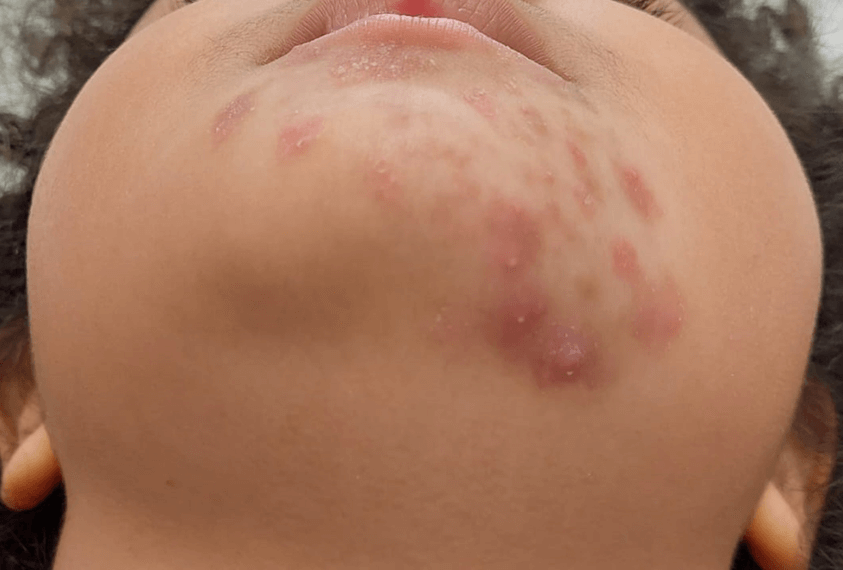 <b>Figure 2.</b> Mentonian plaque with multiple erythematous papules and pustules, with some showing a very subtle scaling border (anteroinferior view).