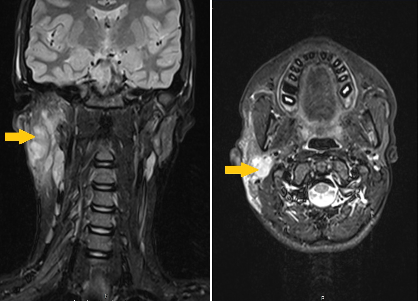 <b>Figure 3.</b> Magnetic resonance imaging (MRI) findings.