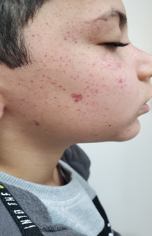<b>Figure 1.</b> Petechial and purpuric lesions on face of the child which sparing the neck.