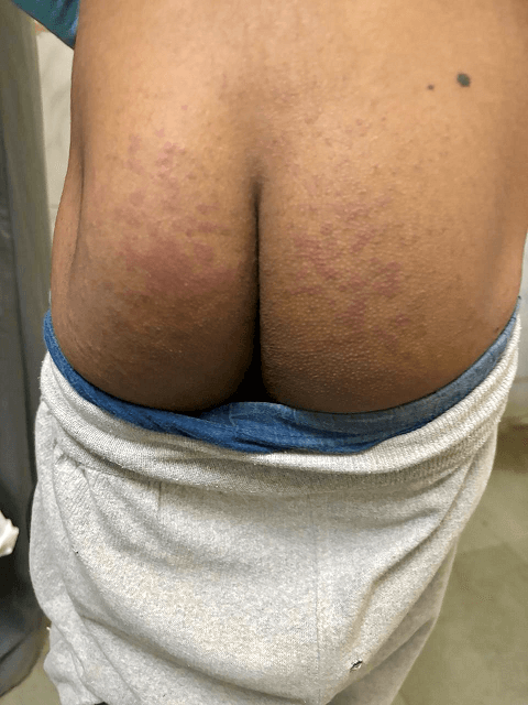 <b>Figure 2.</b> Extension of purpuric lesions to the gluteal region, typical of HSP.