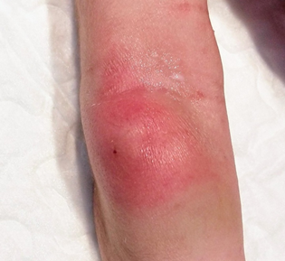 <b>Illustration 1.</b> Abscess in the right forearm 