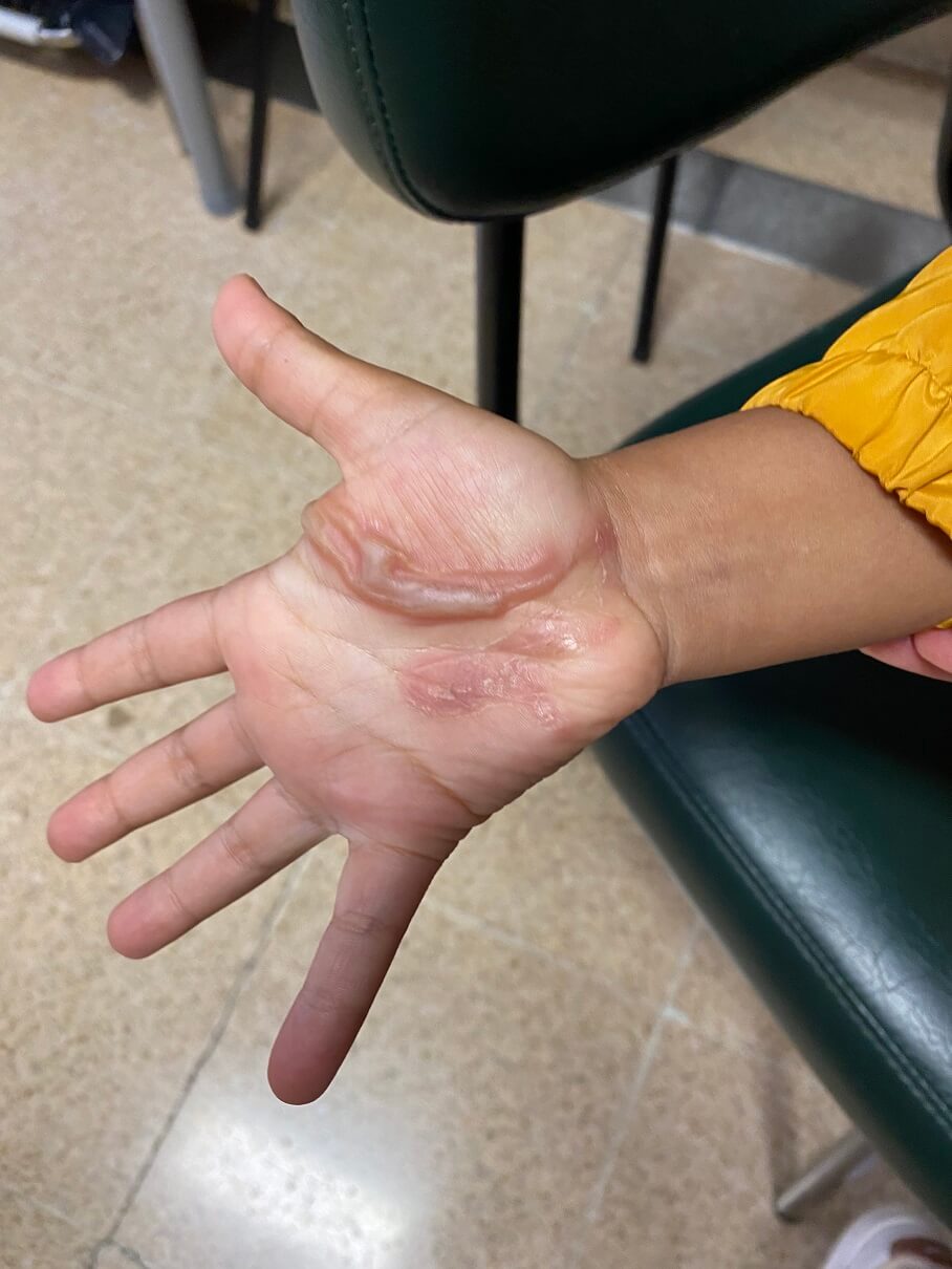 <b>Figure 2.</b> The second observation of the hand lesion (one week later).