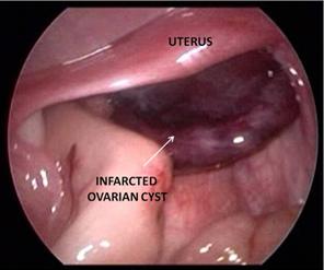 intermittent ovarian torsion