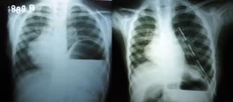 <b>Figure 1: Eventration of left diaphragm (pre-plication) with post-plication normal position</b>