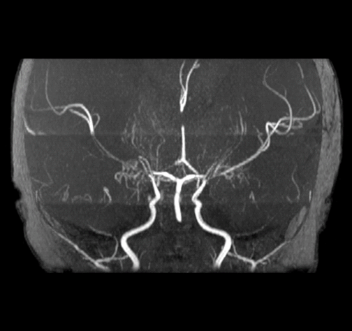 <b>Figure 2</b> MR angiography showed a bilateral pre-obliterative stenosis of the distal ICA and proximal segments of the anterior and middle cerebral arteries.