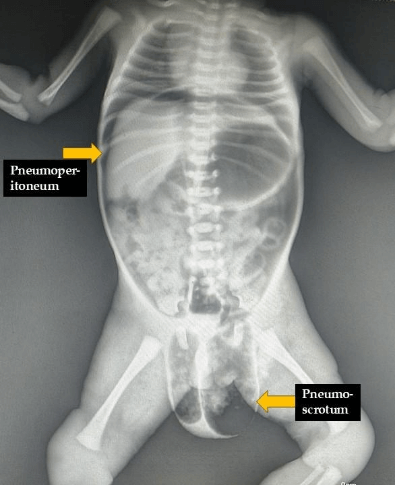 <b>Figure 1.</b> X-ray showing Pneumoperitoneum and Pneumoscrotum.