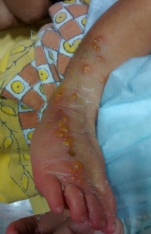 All that Blisters is not Herpes