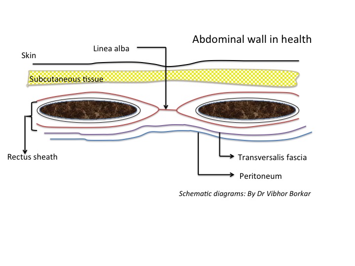 Umbilical Hernia Diseases And Conditions Pediatric Oncall