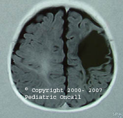 encephalomalacia diagnosis question