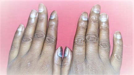 Nail Changes in a Child with Acute Lymphoblastic Leukemia