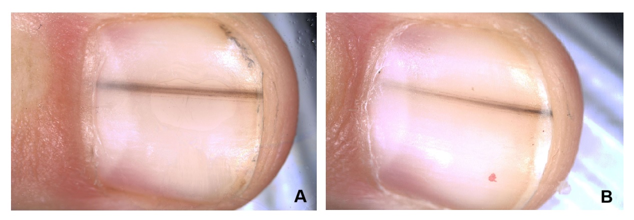 Black linear nail lesion in a preschooler
