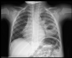Lung Abscess - the answer is in the chest radiograph