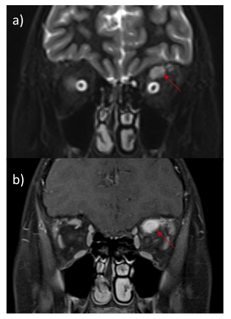 More than meets the eye - a case report of orbital pseudotumor