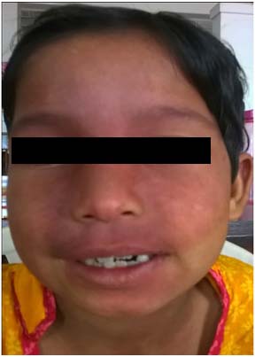 Bilateral Facial Nevus and Transient Recurrent Hemiparesis