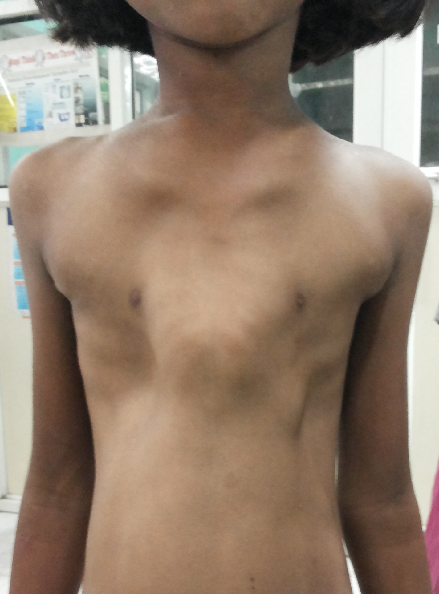Small and Narrow Chest