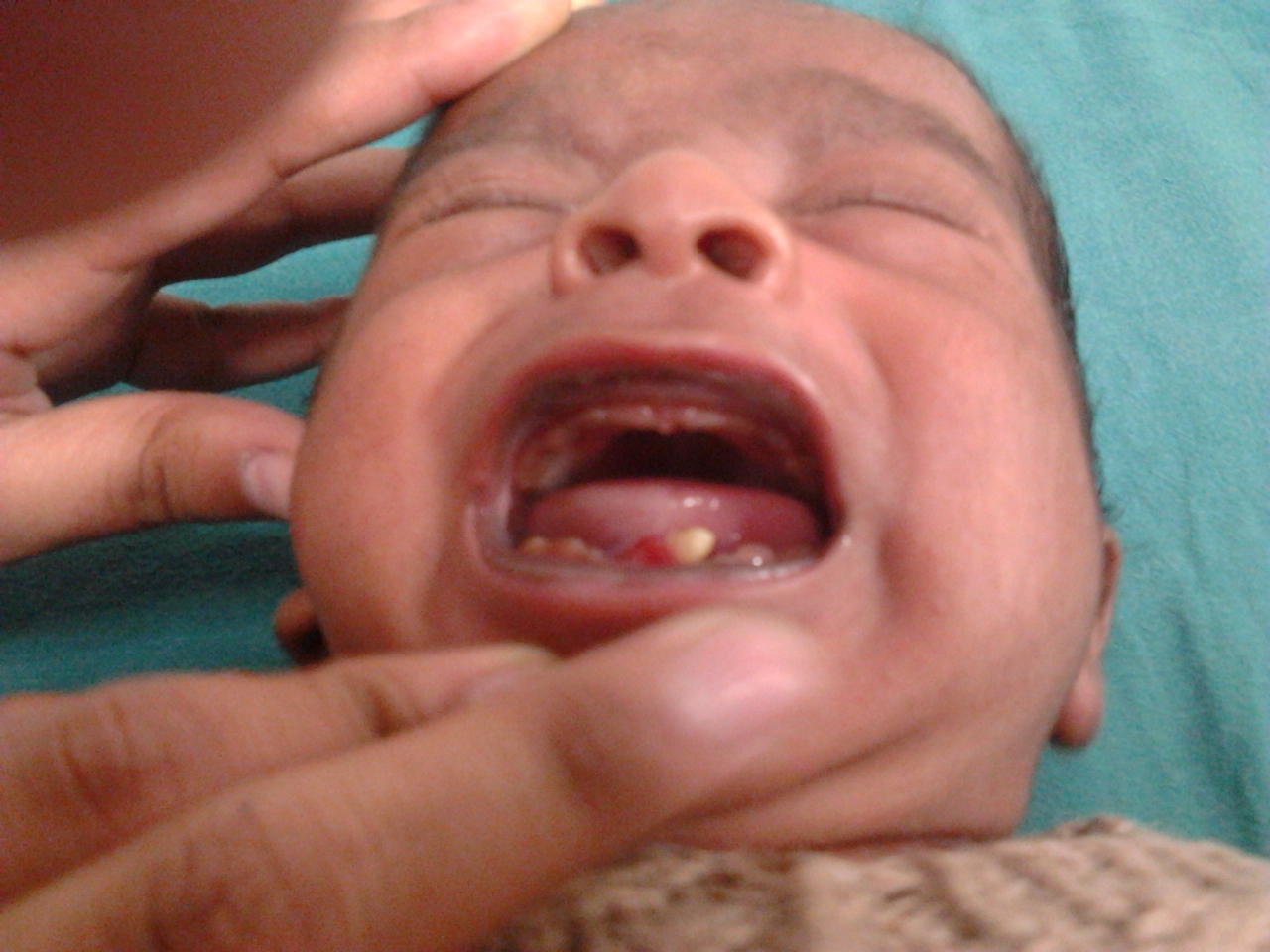 Tooth in a newborn