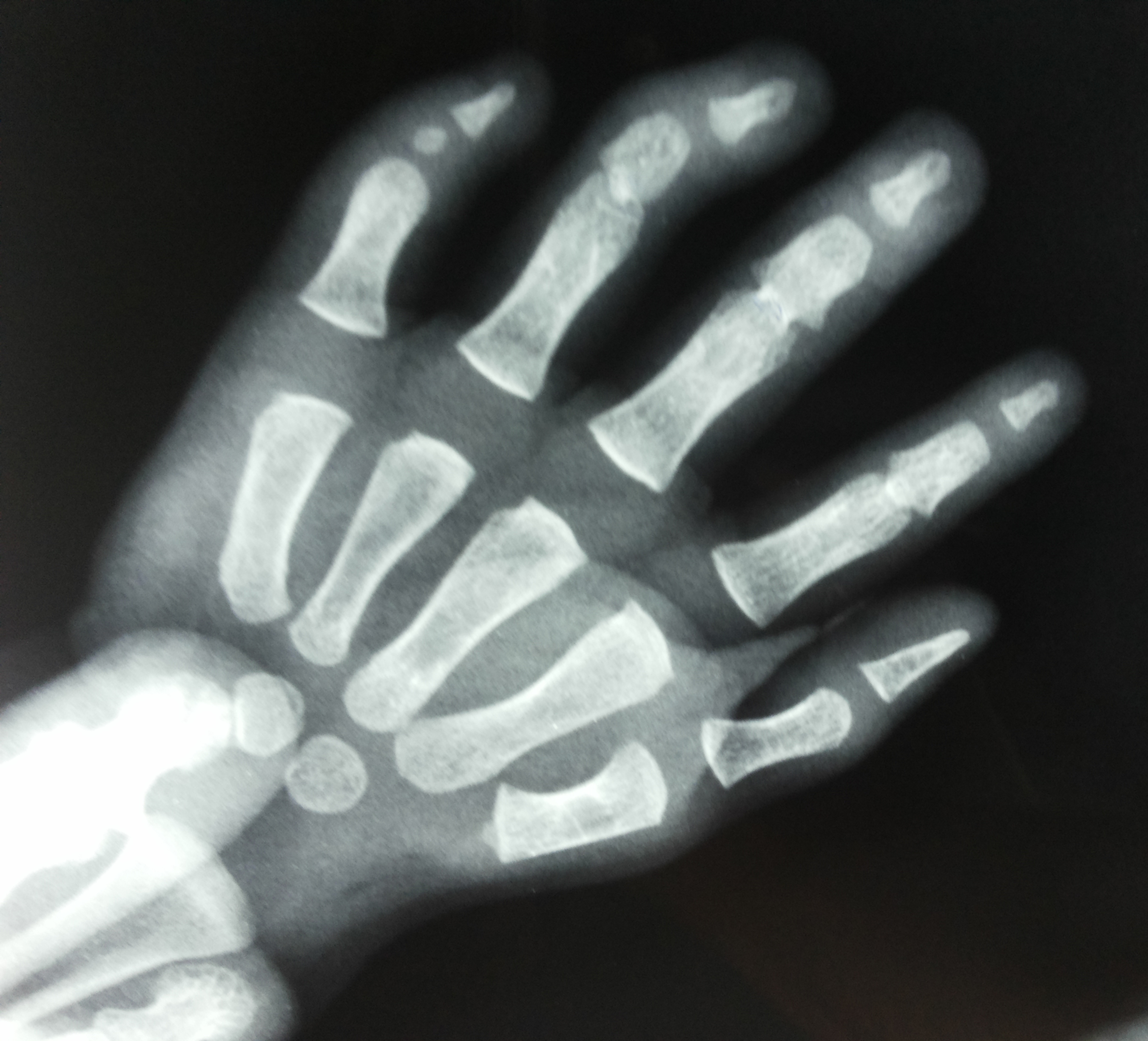 Fusion of interphalangeal joints