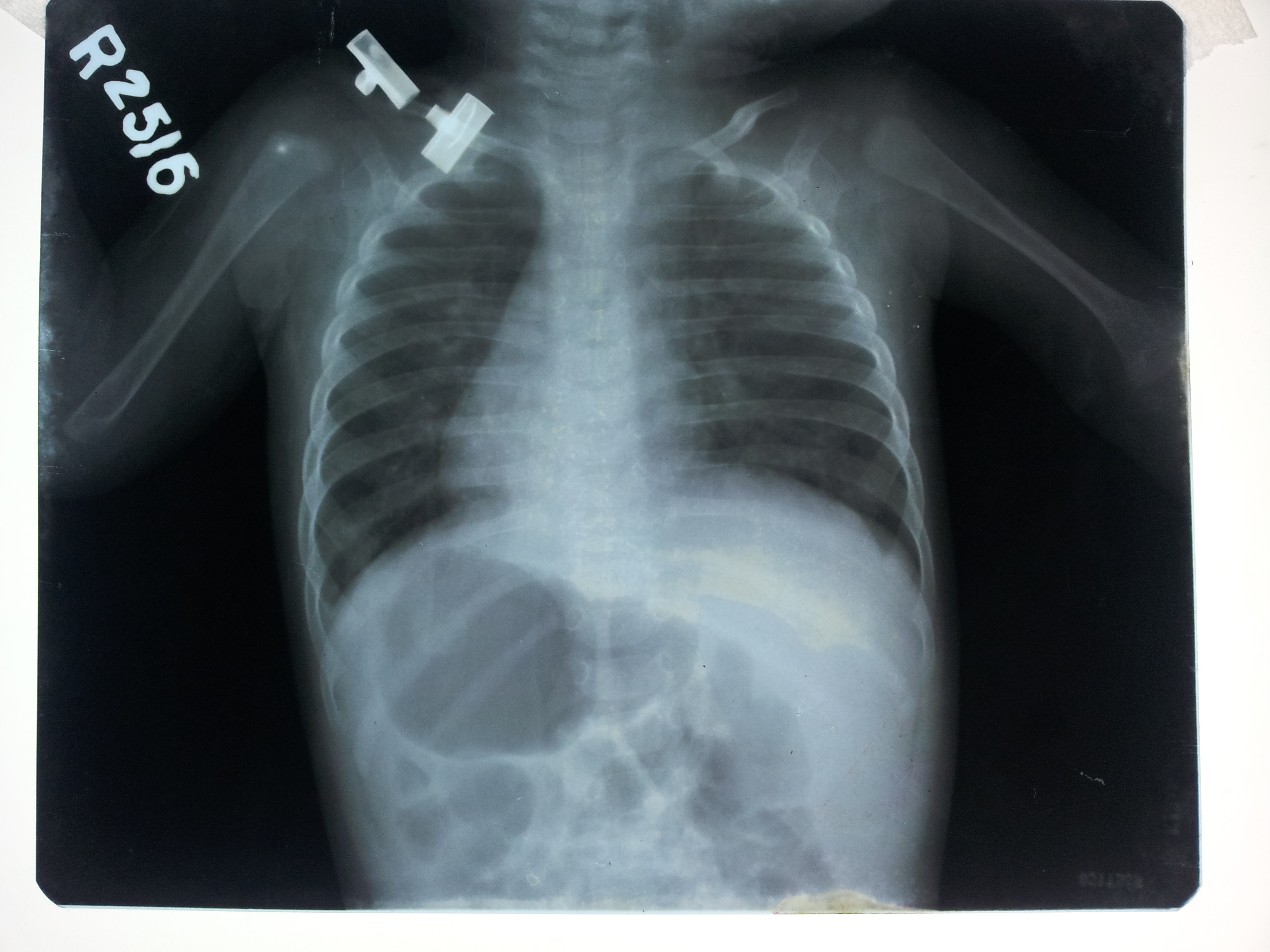 Abnormal Chest X-ray