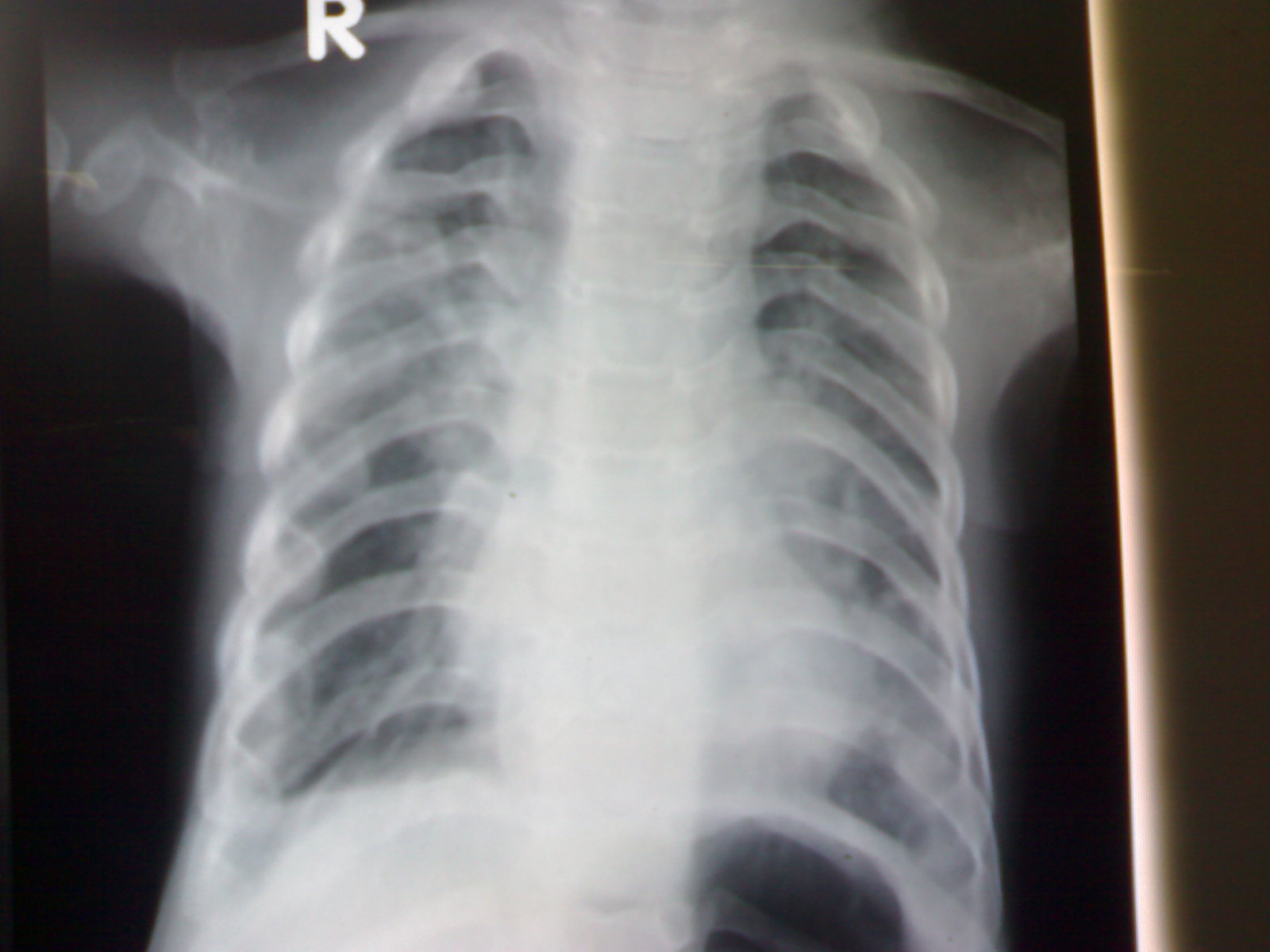 A case of Asphyxiating Thoracic Dystrophy