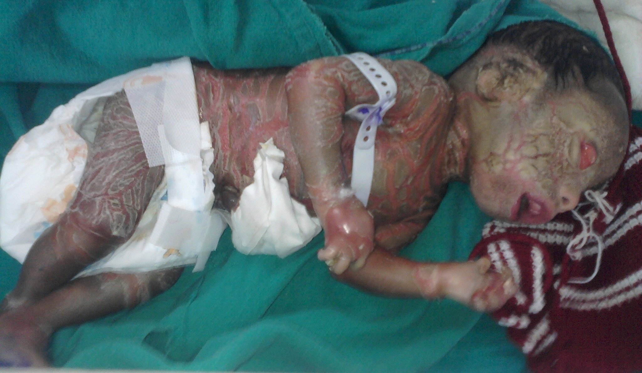Skin lesions at birth