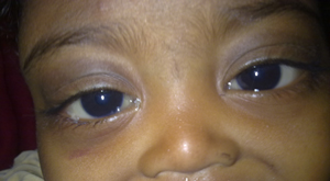 Neuroblastoma with eye involvement
