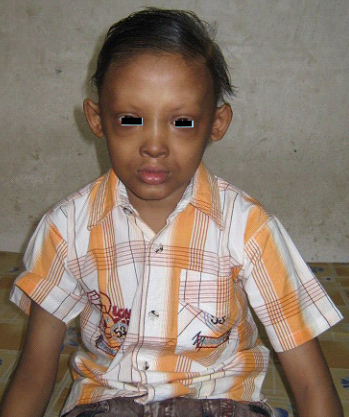 HYPOHIDROTIC ECTODERMAL DYSPLASIA {CHRIST-SIEMENS-TOURAINE SYNDROME}