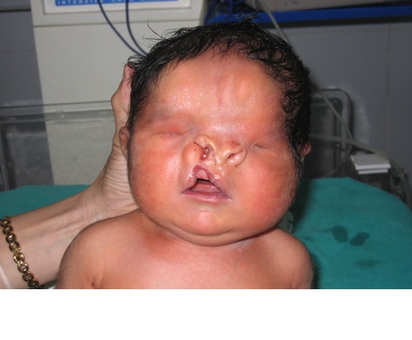 FACIAL ABNORMALITY