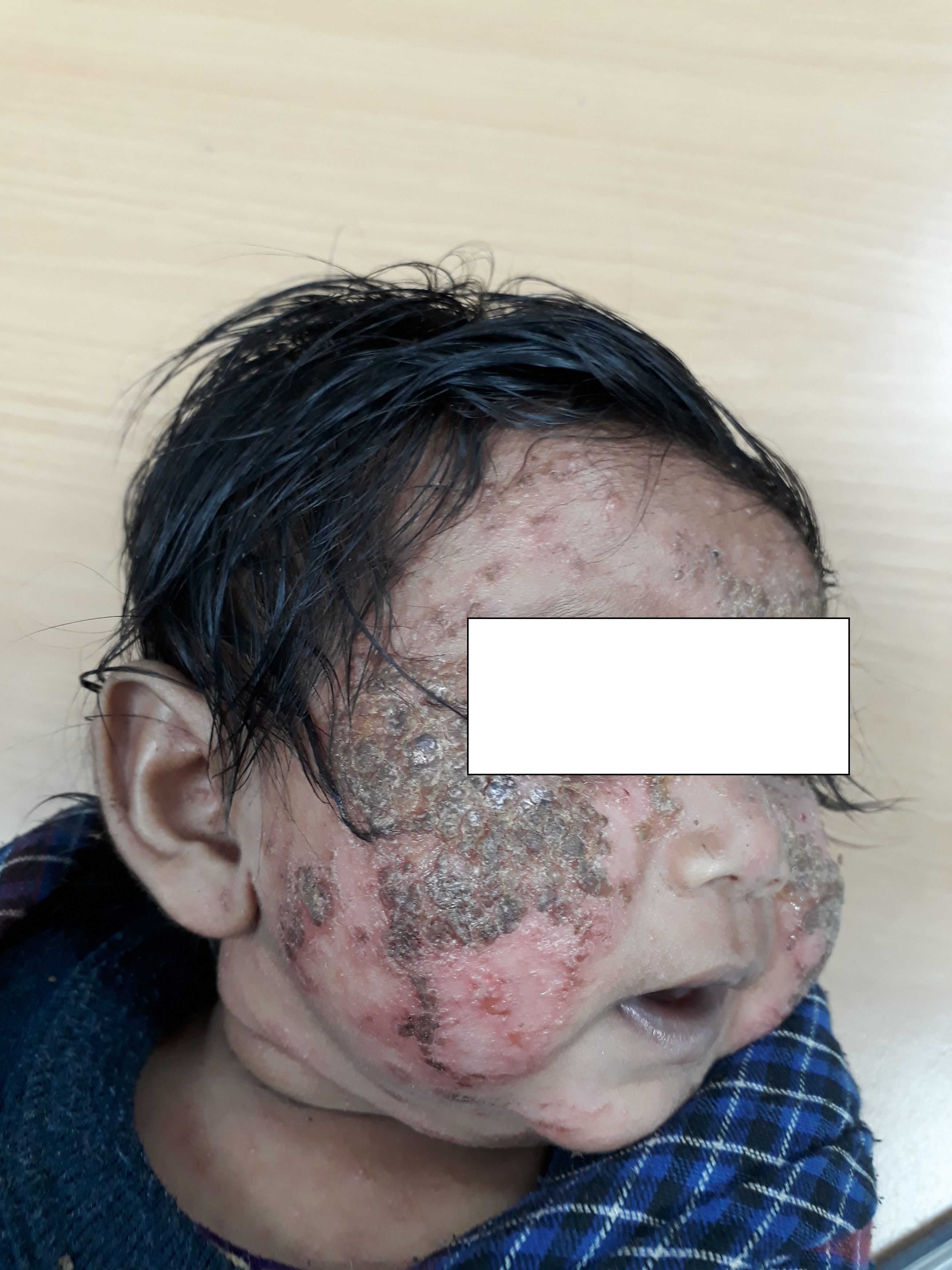 Crusting and Hyperkeratosis in an Infant