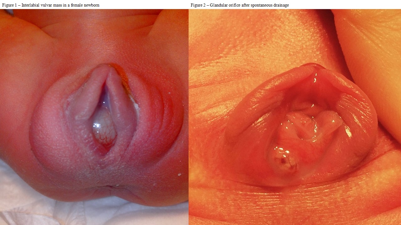 Imperforate Vagina In Mice