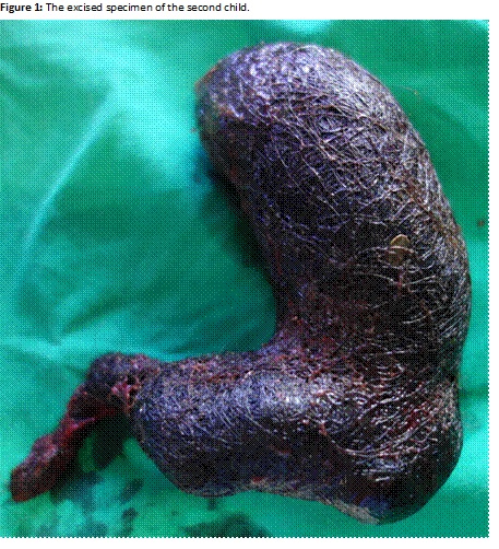 Gastric masses {Trichobezoar with Rapunzel Syndrome}